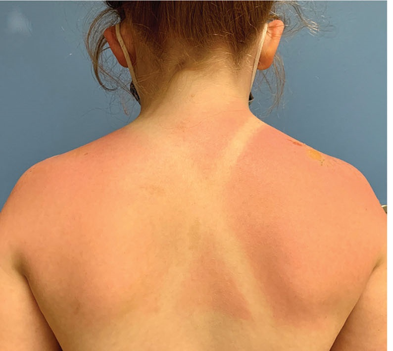 创面修复抗菌敷料怎么用走进创面修复：不同深度和治疗阶段的烧伤创面如何选择敷料？_https://www.jmylbn.com_新闻资讯_第2张