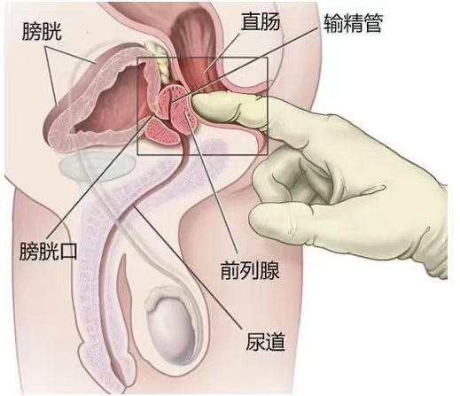 尿管怎么固定护士，导尿管二次固定位置你可能选错了！_https://www.jmylbn.com_新闻资讯_第7张