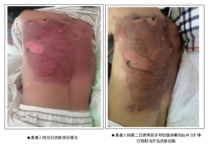 医疗神灯怎么用一例百多邦喷雾剂合并TDP神灯照射治疗背部浅Ⅱ°烧烫伤早期患者的护理案例分享_https://www.jmylbn.com_新闻资讯_第2张