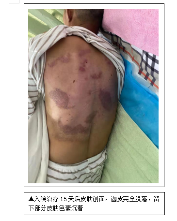 医疗神灯怎么用一例百多邦喷雾剂合并TDP神灯照射治疗背部浅Ⅱ°烧烫伤早期患者的护理案例分享_https://www.jmylbn.com_新闻资讯_第4张