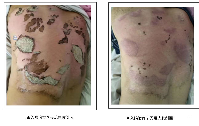 医疗神灯怎么用一例百多邦喷雾剂合并TDP神灯照射治疗背部浅Ⅱ°烧烫伤早期患者的护理案例分享_https://www.jmylbn.com_新闻资讯_第3张