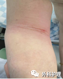 为什么建立双输液通道又双叒肿了，这个位置输液一定要注意！_https://www.jmylbn.com_新闻资讯_第3张