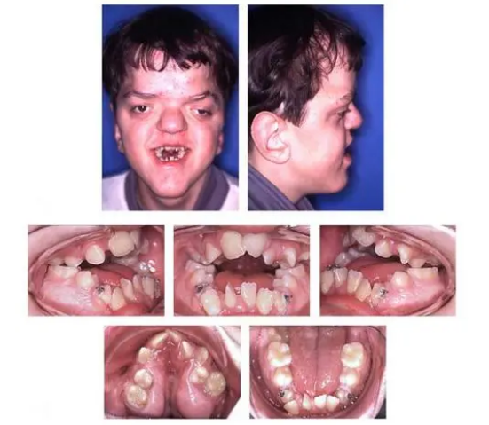 儿童七种常见颅面畸形,你认识哪一种?