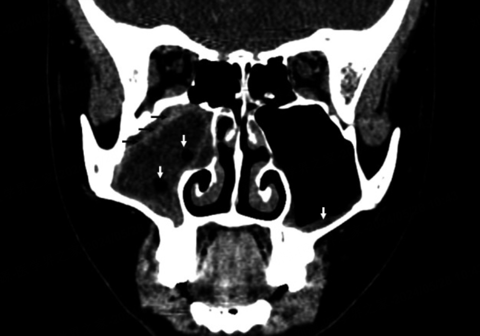 ABS什么药​关于儿童急性细菌性鼻窦炎，如何治疗？这篇文章总结全了_https://www.jmylbn.com_新闻资讯_第2张