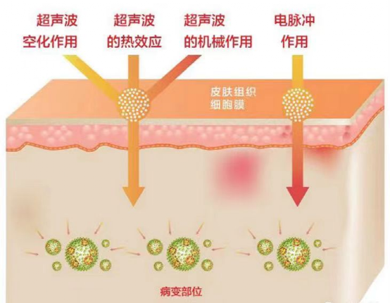 透药有什么作用超声电导透药治疗 ｜ 让中医治疗如虎添翼_https://www.jmylbn.com_新闻资讯_第3张