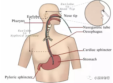 一次性胃管干什么用的胃管，您知多少？_https://www.jmylbn.com_新闻资讯_第1张