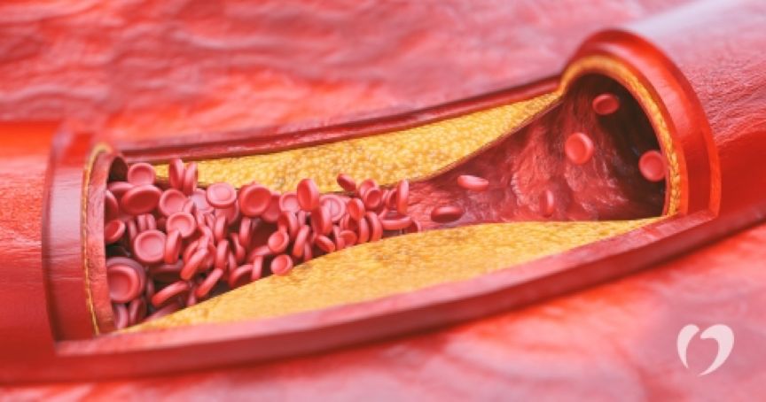 Atherosclerosis 动脉粥样硬化 墨易医学英语 微信公众号文章阅读 Wemp