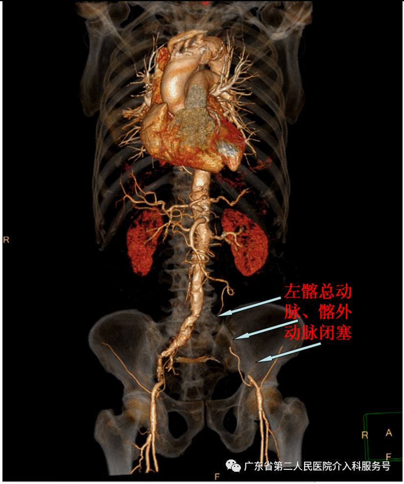 髂外动脉,置入支架后造影显示:双侧髂动脉,股动脉血流通畅