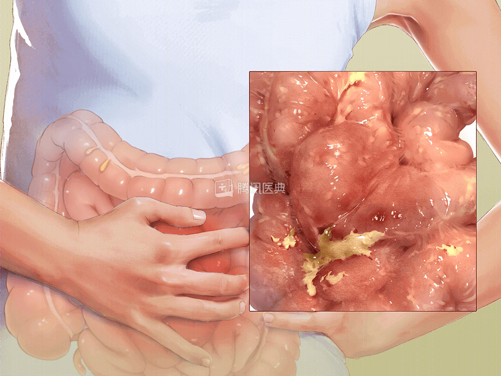 24周早产肠子被切掉早产宝宝一出生就得打仗