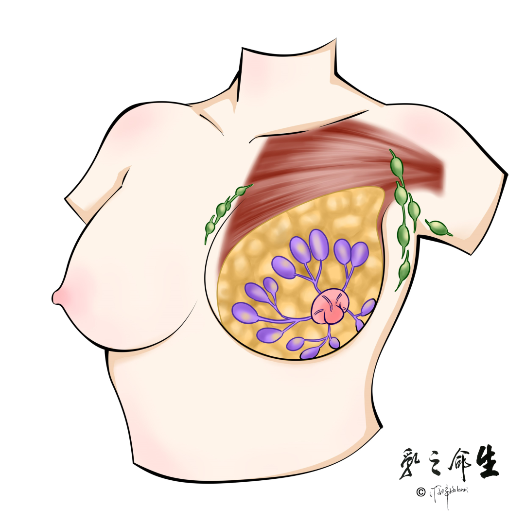 数字钼靶是什么精准+微创：X线数字断层摄影立体定位的乳腺穿刺活检技术_https://www.jmylbn.com_新闻资讯_第1张