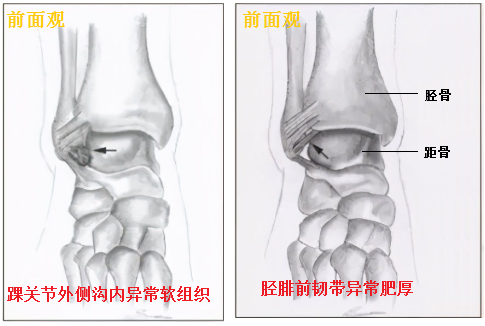 按照撞擊部位的不同,可分為:前外側撞擊綜合症,前撞擊綜合症,前內側