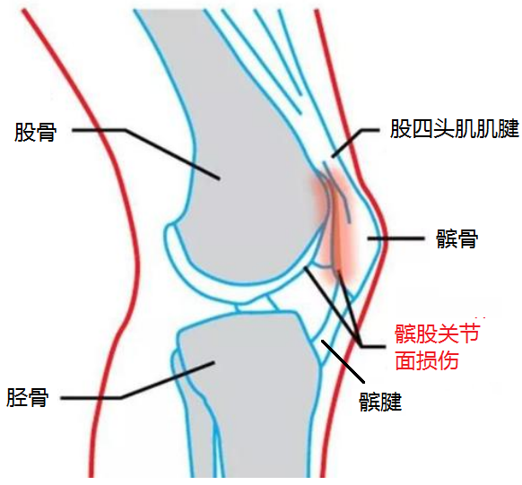 健康跑步后膝盖疼痛警惕跑步膝