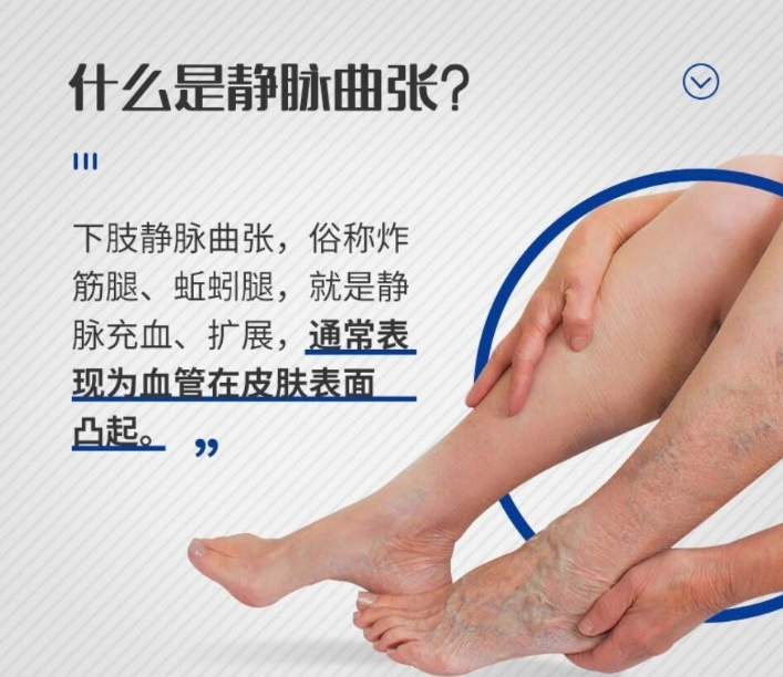 医用弹力袜用什么洗【科普】医用弹力袜，您穿对了吗？_https://www.jmylbn.com_新闻资讯_第4张
