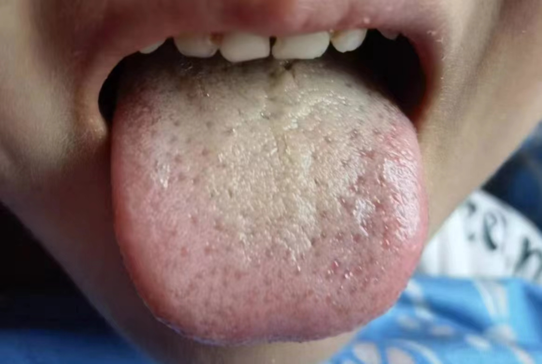 服用阿奇霉素的孩子都要吃这个药！