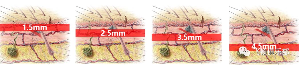 多极射频是什么【科普】射频RF应用于医美抗衰发展历程_https://www.jmylbn.com_新闻资讯_第15张
