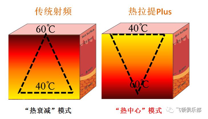 多极射频是什么【科普】射频RF应用于医美抗衰发展历程_https://www.jmylbn.com_新闻资讯_第14张