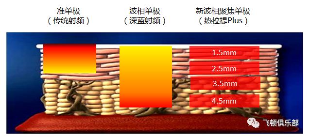 多极射频是什么【科普】射频RF应用于医美抗衰发展历程_https://www.jmylbn.com_新闻资讯_第3张