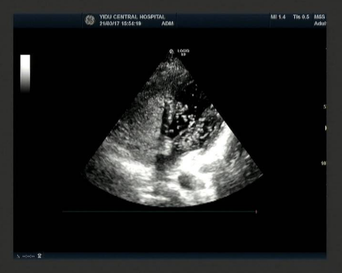 "心有洞,偏头痛"——七问七答:卵圆孔未闭与偏头痛有关?-友友