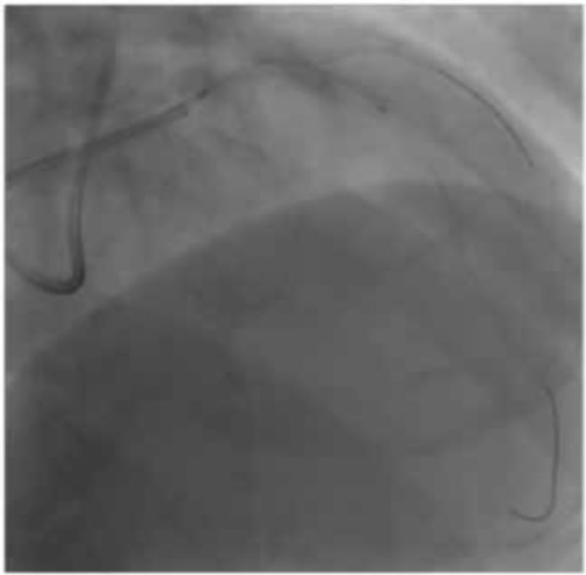 asahi有哪些导丝技术研发与设计思维的完美结合_https://www.jmylbn.com_新闻资讯_第5张