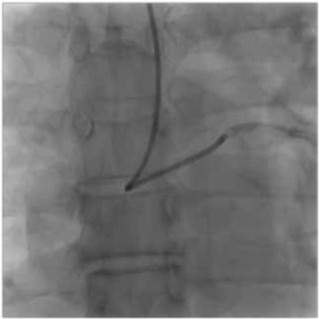 asahi有哪些导丝技术研发与设计思维的完美结合_https://www.jmylbn.com_新闻资讯_第4张