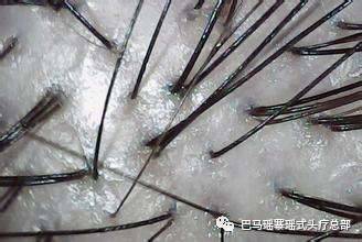 导致“敏感性头皮”的原因有哪些？