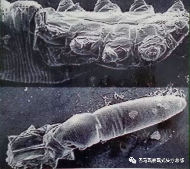 拒绝头螨寄生，还你清爽头皮