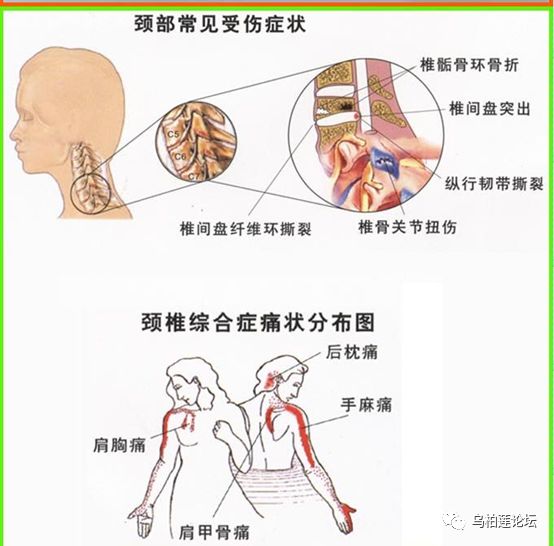 颈椎间盘突出症 为尔草根创业平台 微信公众号文章阅读 Wemp