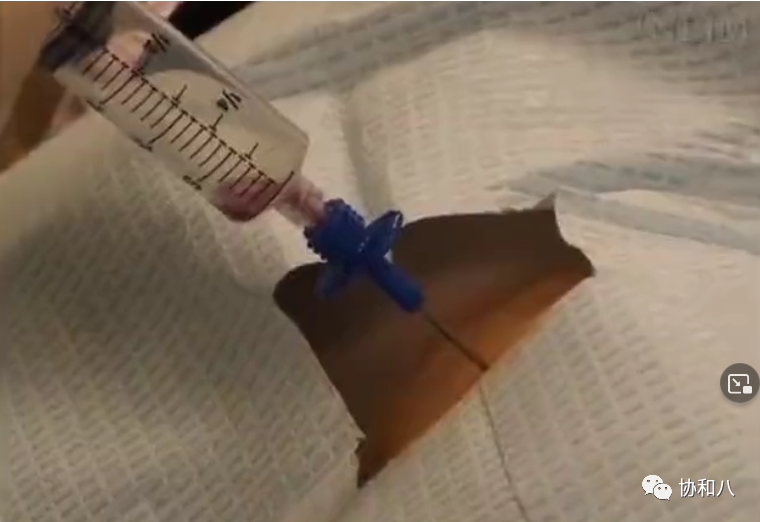 骨髓针是什么给你一次深入骨髓的记忆 ｜ 协和八_https://www.jmylbn.com_新闻资讯_第6张