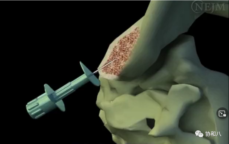 骨髓针是什么给你一次深入骨髓的记忆 ｜ 协和八_https://www.jmylbn.com_新闻资讯_第5张