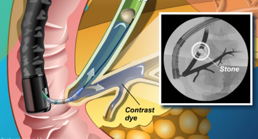 取石球囊怎么取石不开刀就能取胆管结石的方法，你了解吗？ ｜ 一页手册 · 协和八_https://www.jmylbn.com_新闻资讯_第2张