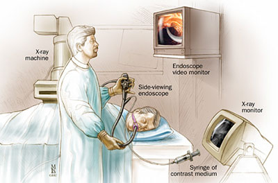 取石球囊怎么取石不开刀就能取胆管结石的方法，你了解吗？ ｜ 一页手册 · 协和八_https://www.jmylbn.com_新闻资讯_第1张