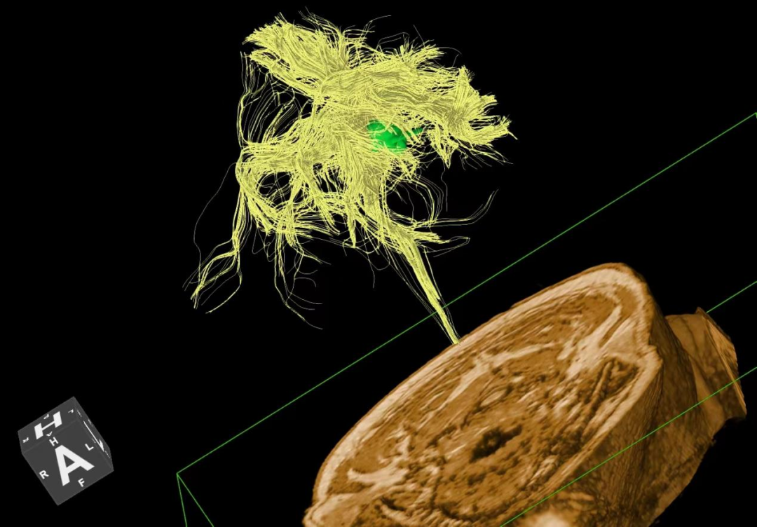 联影磁共振怎么样开启高精度诊断新模式！联影光梭3.0T磁共振落户周口市中心医院_https://www.jmylbn.com_新闻资讯_第8张