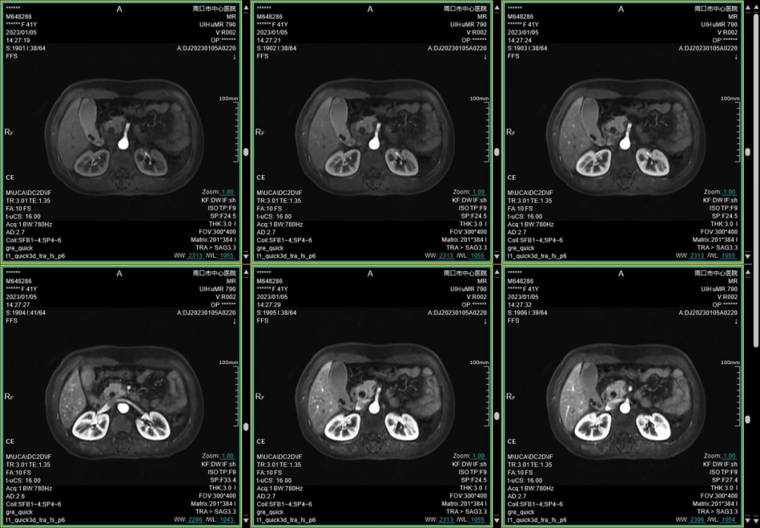 联影磁共振怎么样开启高精度诊断新模式！联影光梭3.0T磁共振落户周口市中心医院_https://www.jmylbn.com_新闻资讯_第5张