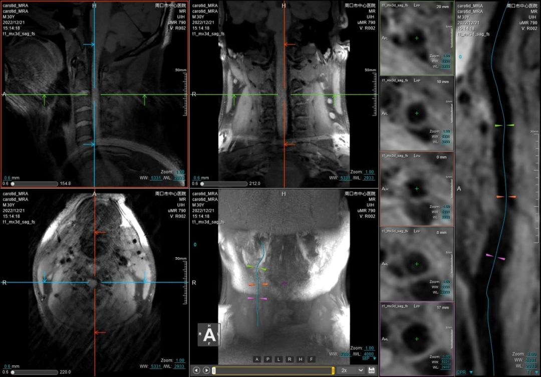 联影磁共振怎么样开启高精度诊断新模式！联影光梭3.0T磁共振落户周口市中心医院_https://www.jmylbn.com_新闻资讯_第4张