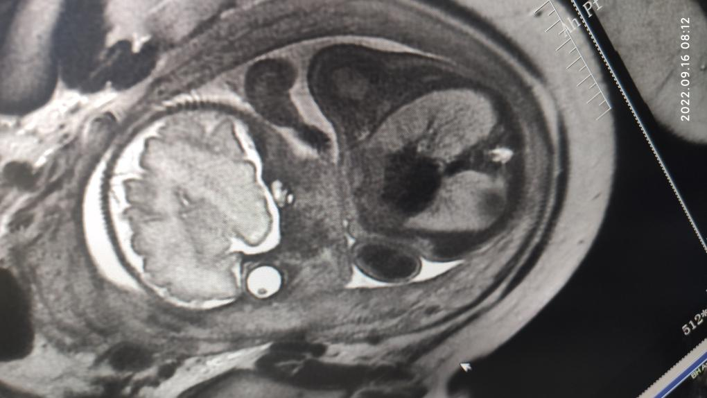 联影磁共振怎么样开启高精度诊断新模式！联影光梭3.0T磁共振落户周口市中心医院_https://www.jmylbn.com_新闻资讯_第11张