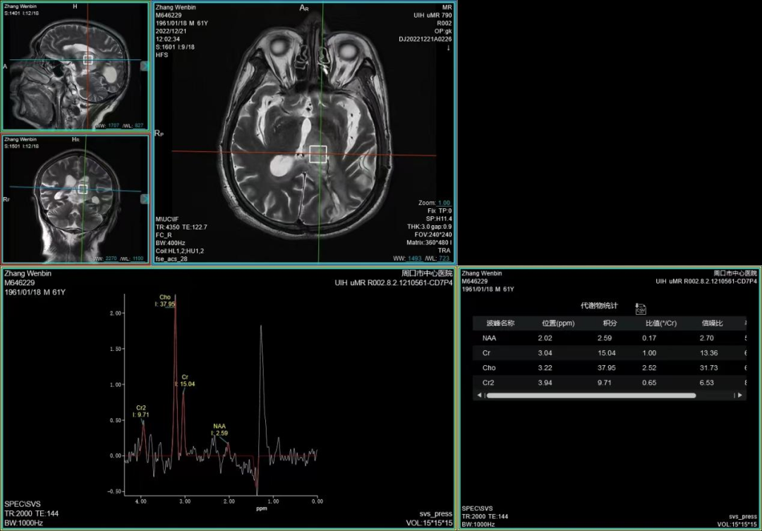 联影磁共振怎么样开启高精度诊断新模式！联影光梭3.0T磁共振落户周口市中心医院_https://www.jmylbn.com_新闻资讯_第7张