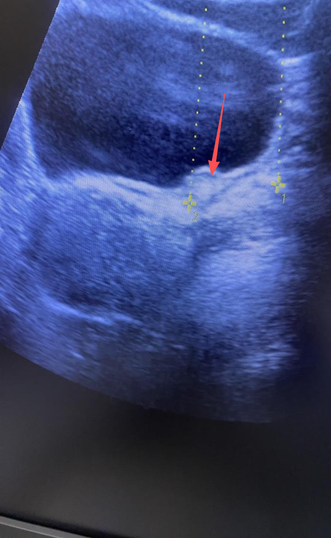 体外碎石b超怎么定位结石患者的福音！ “X光+B超”双定位体外冲击波碎石机落户周口市中心医院文昌路院区_https://www.jmylbn.com_新闻资讯_第9张