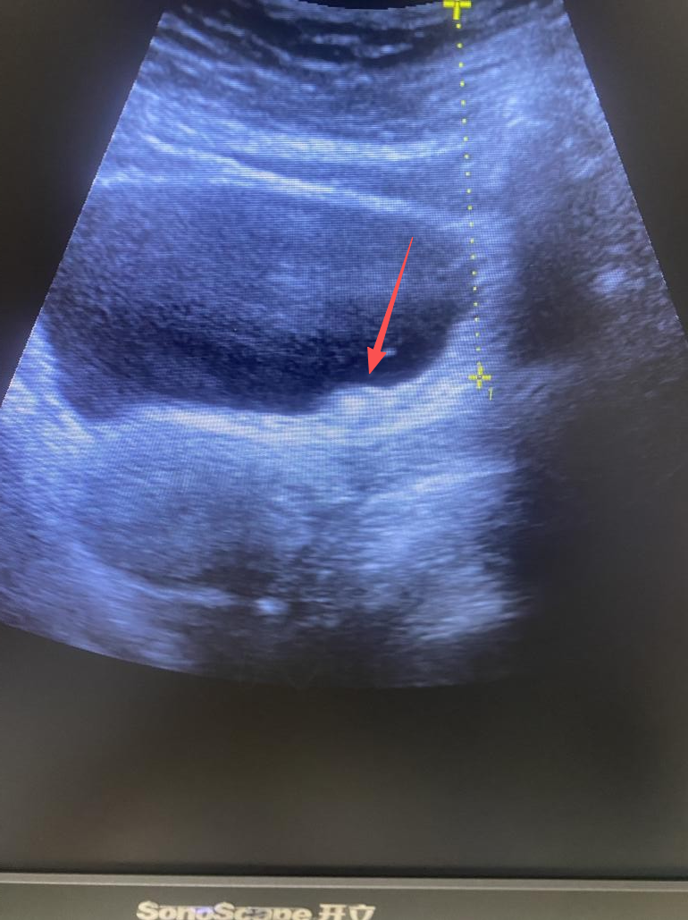 体外碎石b超怎么定位结石患者的福音！ “X光+B超”双定位体外冲击波碎石机落户周口市中心医院文昌路院区_https://www.jmylbn.com_新闻资讯_第10张