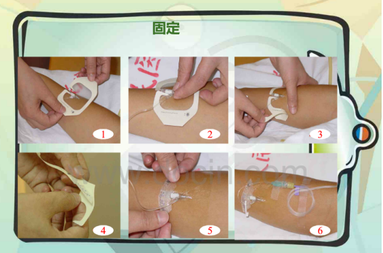 什么是安全留置针【健康科普】留置针居家护理10要点，少疼痛，更安全！_https://www.jmylbn.com_新闻资讯_第4张