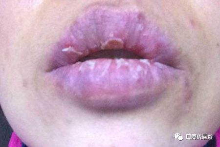 唇炎是怎么引起的 长了唇炎怎么办 口周炎唇炎 微信公众号文章阅读 Wemp