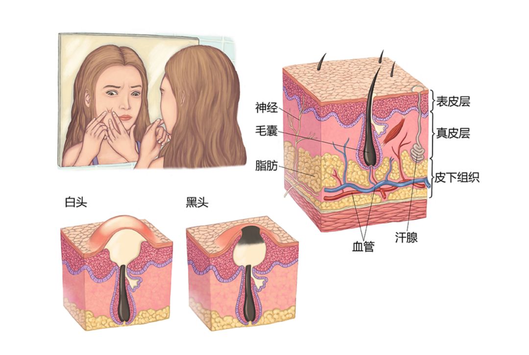 皮肤管理|揭开黑头面纱，看看哪些原因导致你的黑头去不掉。