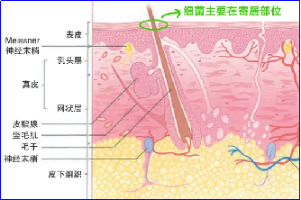 备皮刀怎么使用如何规范进行术前皮肤准备？又不增加手术部位感染（SSI）风险_https://www.jmylbn.com_新闻资讯_第8张