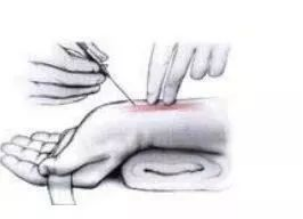 桡动脉鞘怎么读浅谈经皮桡动脉介入穿刺术的相关管理_https://www.jmylbn.com_新闻资讯_第2张