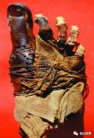 纱布敷料怎么用浅谈伤口敷料的发展简史_https://www.jmylbn.com_新闻资讯_第14张