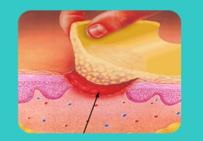 医用泡沫敷料怎么用浅谈泡沫敷料简史及其临床应用_https://www.jmylbn.com_新闻资讯_第3张