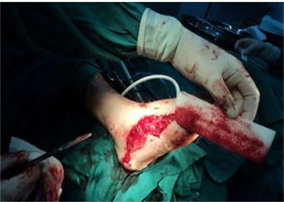 德湿银敷料怎么使用浅谈伤口清创技术及工具_https://www.jmylbn.com_新闻资讯_第17张