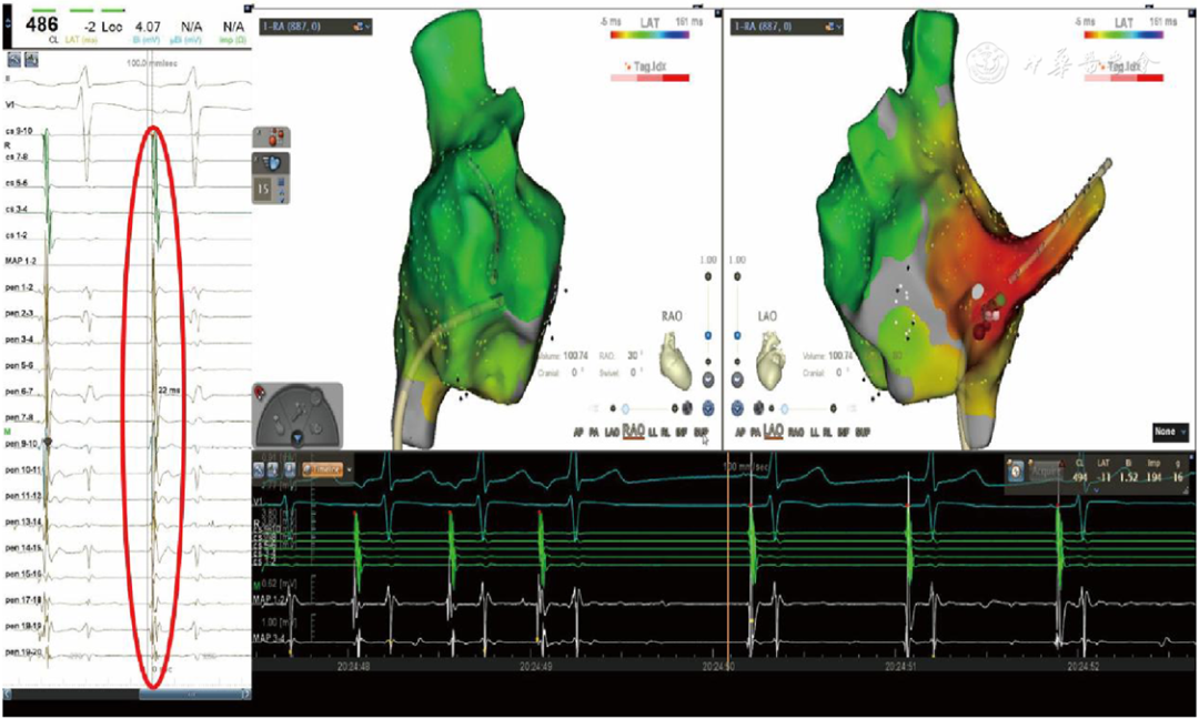 胎儿超声心电图是什么病例报告丨妊娠合并房性心动过速所致心动过速性心肌病1例_https://www.jmylbn.com_新闻资讯_第4张