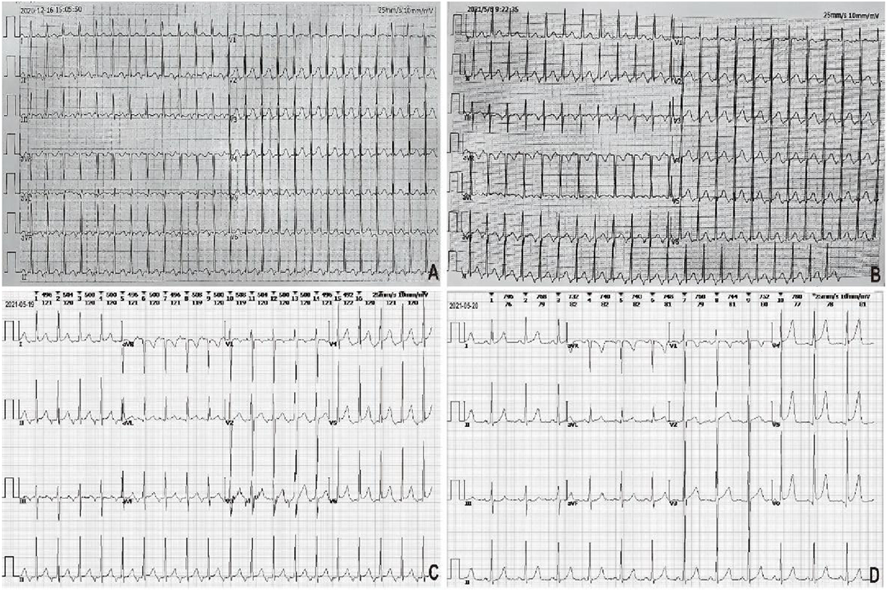胎儿超声心电图是什么病例报告丨妊娠合并房性心动过速所致心动过速性心肌病1例_https://www.jmylbn.com_新闻资讯_第1张