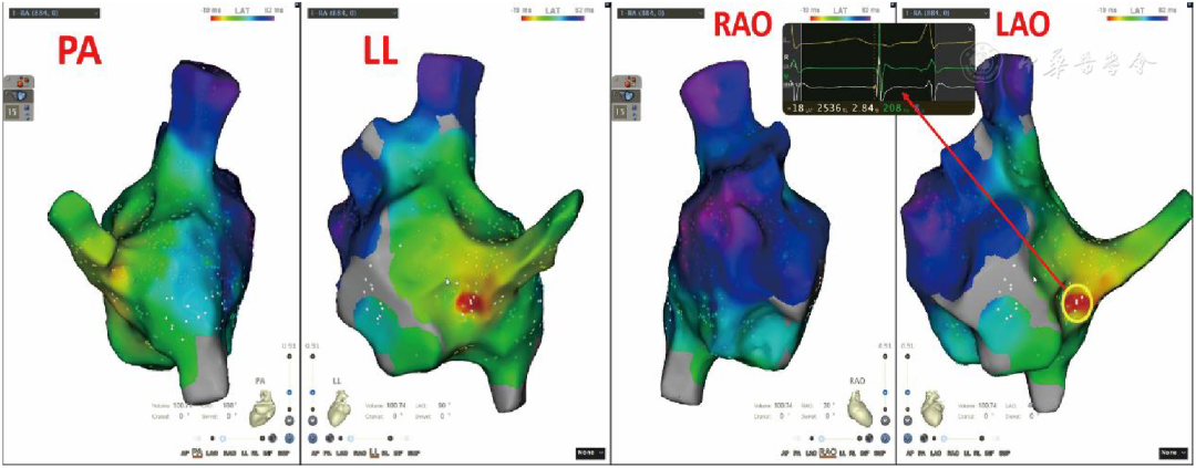 胎儿超声心电图是什么病例报告丨妊娠合并房性心动过速所致心动过速性心肌病1例_https://www.jmylbn.com_新闻资讯_第3张