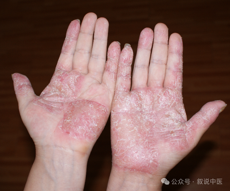 治疗鹅掌风的一些古方